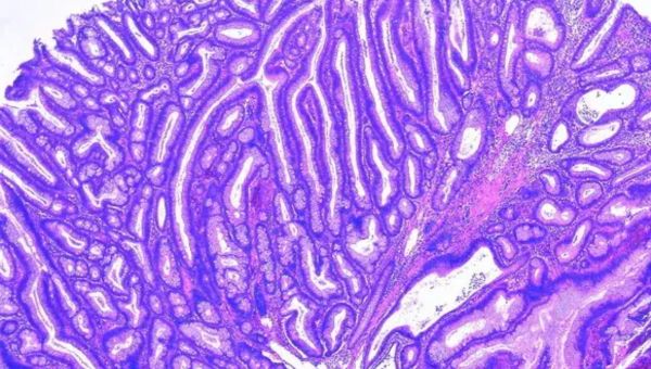 Image20260305-tubulovillous